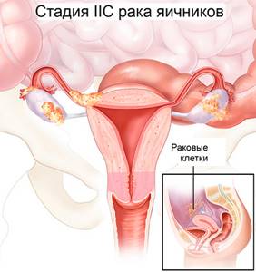 Опухоль яичника у женщин: симптомы, лечение, операция и прогноз