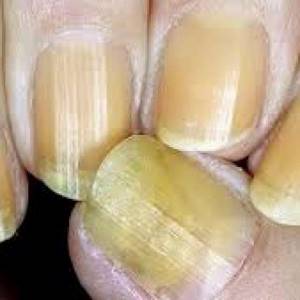 Гранулёма ногтя: лечение, фото, симптомы и причины