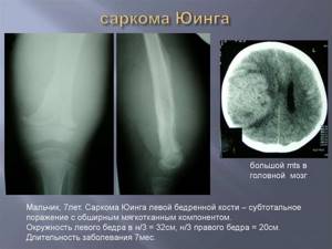 Саркома Юинга: симптомы, фото, прогноз выживаемости и лечение