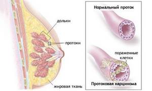 Протоковый рак молочной железы: виды, симптомы, прогноз, лечение и степени