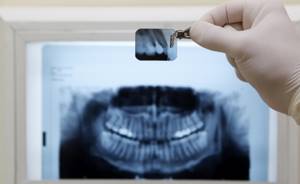 Гранулёма зуба: лечение, симптомы, фото, опасность, причины и снятие боли