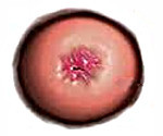 Плоскоклеточный рак шейки матки: виды, прогноз, лечение, причины и симптомы