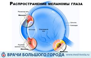 Меланома глаза: фото начальной стадии, лечение и прогноз