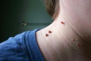 Фиброма кожи: лечение, фото, симптомы, чем опасна