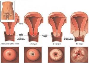 Плоскоклеточный рак шейки матки: виды, прогноз, лечение, причины и симптомы
