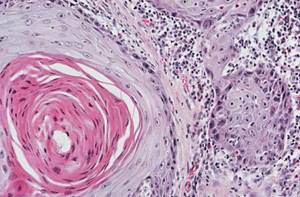 Плоскоклеточный рак лёгкого: стадии, прогноз, лечение и симптомы