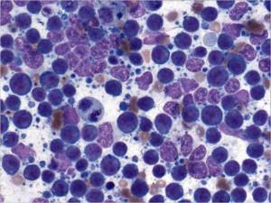 Нейтрофилы понижены, лимфоциты повышены: причины, о чём это говорит