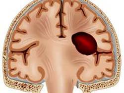 Гигрома головного мозга: виды, лечение, симптомы и причины