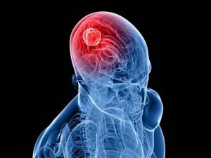 Опухоль головного мозга: симптомы на ранних стадиях, лечение и удаление