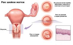 Рак шейки матки 3 стадии: сколько живут после операции, прогноз продолжительности жизни и выздоровления