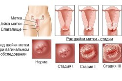 Рак матки: причины, первые признаки и симптомы, виды, лечение и диагностика