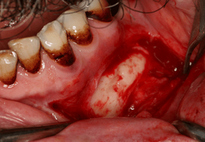Остеома нижней челюсти: симптомы, лечение, фото и удаление
