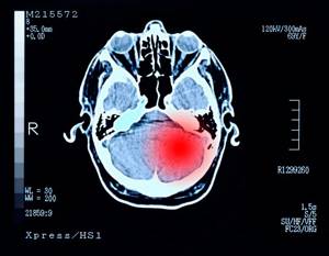 Доброкачественная опухоль головного мозга: симптомы, лечение, удаление и продолжительность жизни