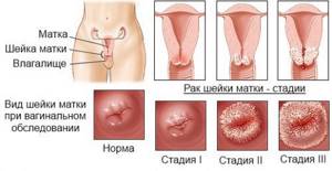 Рак матки: причины, первые признаки и симптомы, виды, лечение и диагностика