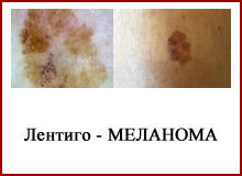 Лентиго-меланома: стадии, фото и прогноз