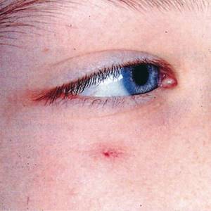 Ангиома кожи: фото, лечение, симптомы у взрослых и детей