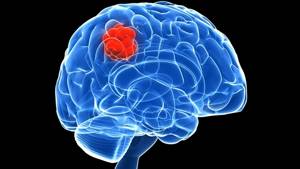 Опухоль головного мозга: симптомы на ранних стадиях, лечение и удаление