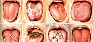 Рак языка: фото начальной стадии, симптомы, прогноз и лечение