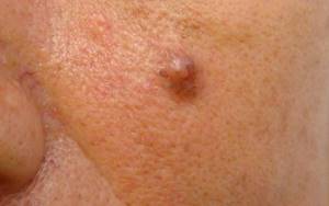 Базальноклеточный рак кожи: фото начальной стадии, лечение, прогноз и симптомы
