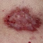 Плоскоклеточный рак кожи: фото начальной стадии, лечение, симптомы, прогноз и метастазы