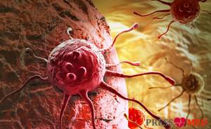 Симптомы рака: как распознать на ранней стадии, первые признаки и проявление