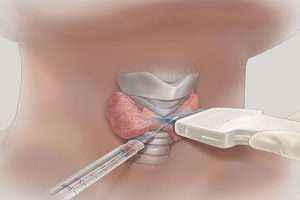 Токсическая аденома щитовидной железы: симптомы, лечение, операция