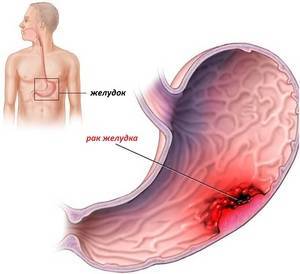 Метастазы рака желудка: какие органы поражают метастазы, сколько живут с метастазами
