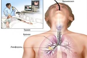 Лимфоузлы в лёгких: причины увеличения, расположение и лечение воспаления