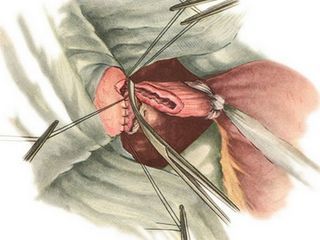 Удаление желудка при раке: срок жизни и последствия операции