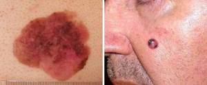 Рак кожи: фото начальной стадии, симптомы, лечение и диагностика