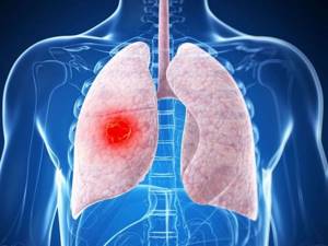 Саркома лёгких: симптомы, признаки, лечение и прогноз