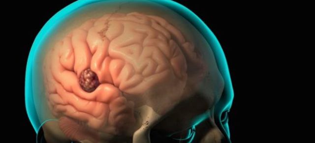 Доброкачественная опухоль головного мозга: симптомы, лечение, удаление и продолжительность жизни