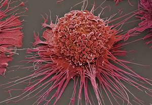 Плоскоклеточный рак гортани: виды, симптомы, стадии и прогноз