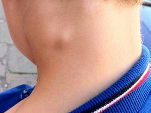 Жировик на шее: фото, причины и быстрое лечение