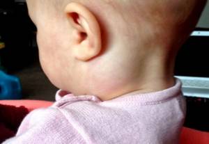 У ребёнка увеличены лимфоузлы на шее: причины, лечение, симптомами каких болезней является