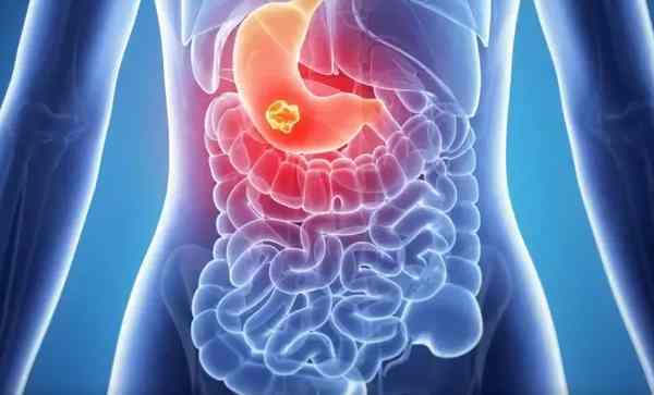 Метастазы рака желудка: какие органы поражают метастазы, сколько живут с метастазами