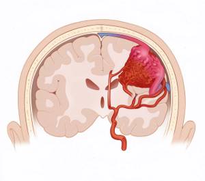 Ангиома головного мозга: лечение, удаление, прогноз жизни и последствия