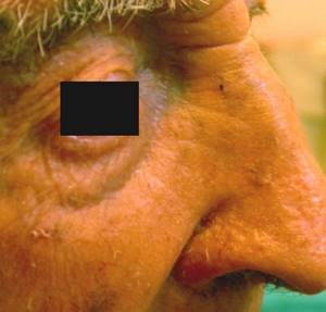 Базалиома на носу: фото, облучение, признаки и лечение