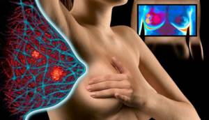 Метастазы рака молочной железы: куда метастазирует, симптомы и лечение