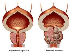 Опухоль мочевого пузыря: виды, симптомы, лечение, удаление у мужчин и женщин