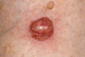 Базальноклеточный рак кожи на начальной стадии: фото, симптомы и лечение