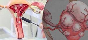 Интерстициальная миома матки: симптомы, размеры и лечение