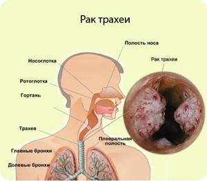 Рак трахеи: причины, симптомы, стадии, лечение и диагностика
