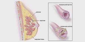 Инвазивный рак молочной железы: типы, симптомы, прогноз и лечение