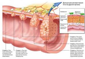 Рак тонкого кишечника: симптомы, диагностика, стадии и лечение