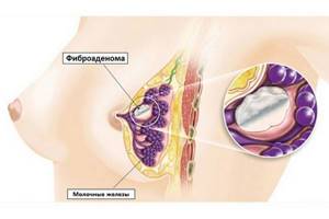 Фиброаденома молочной железы: когда удалять, размеры для операции