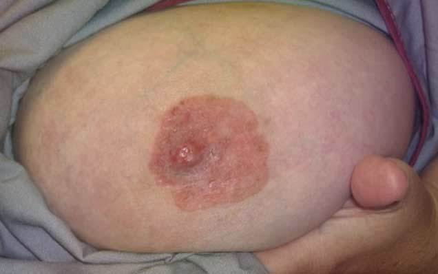 Рак Педжета: фото, причины, симптомы и стадии поражения соска молочной железы