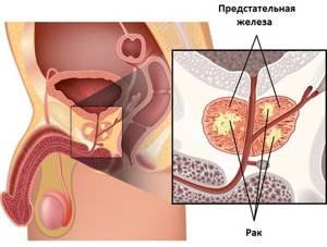 Брахитерапия: эффективность при лечении рака предстательной железы