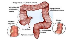 Опухоль кишечника: симптомы, удаление, лечение и прогноз