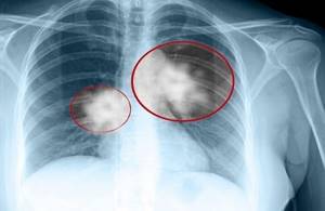 Рак лёгких 2 стадии: прогноз жизни, лечение, симптомы и виды